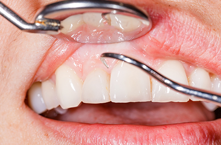 「歯茎の腫れ」「出血」の原因は歯周病かもしれません