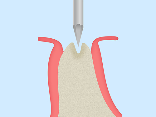 スプリットクレスト法（歯槽堤分割術）